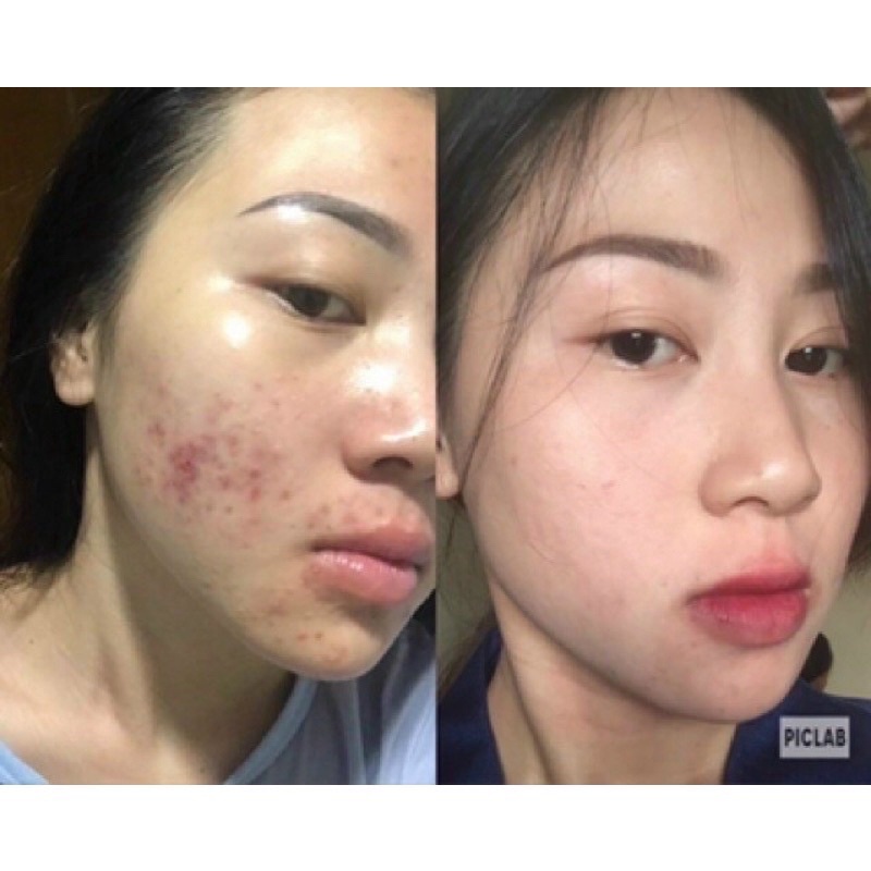 Serum giảm mụn thâm rỗ - Skin 7 Days - Công dụng 5 trong 1 hiệu quả sau 7 ngày