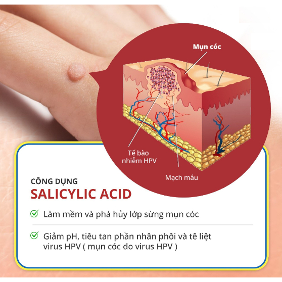 Miếng Dán Mụn Cóc Dứt Điểm Tại Nhà Từ Sau Hơn 1 Tuần - Corn plaster