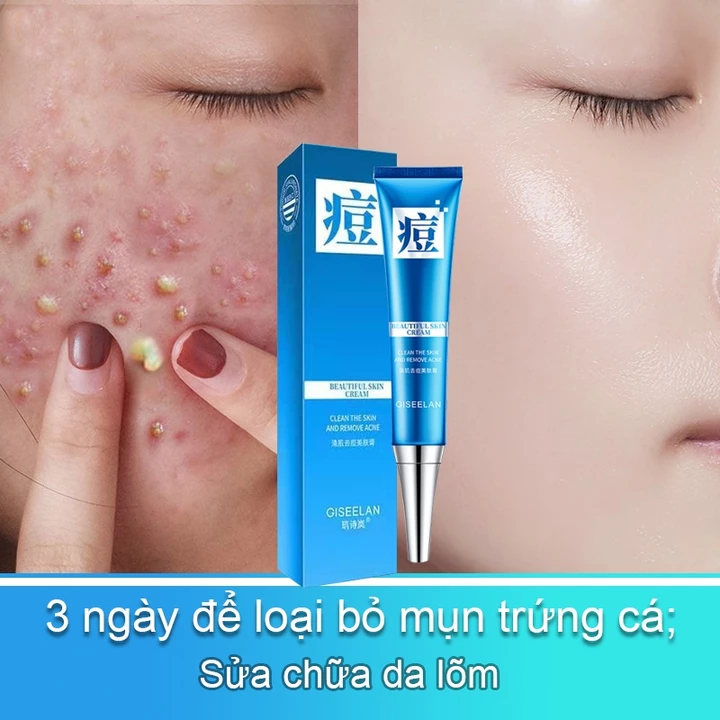 【Chính hãng】hiệu quả cao Tinh chống mụn sửa chữatinh chất nghệ mụn kem nghệ mụn tinh chất nghệ mụn gel lột mụn nhanh kem