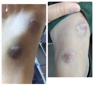 Cao Xoá Sẹo Collagen Mờ Sẹo Lồi Lõm Giúp Nhanh Lành Vết Thương Không Để Lại Sẹo