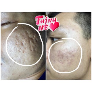 Cao Xoá Sẹo Collagen Mờ Sẹo Lồi Lõm Giúp Nhanh Lành Vết Thương Không Để Lại Sẹo