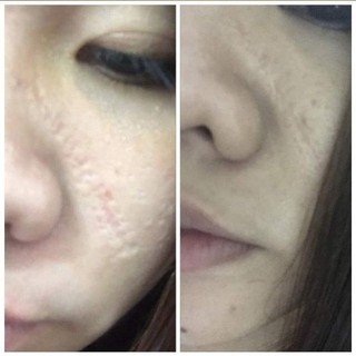 Cao Xoá Sẹo Collagen Mờ Sẹo Lồi Lõm Giúp Nhanh Lành Vết Thương Không Để Lại Sẹo