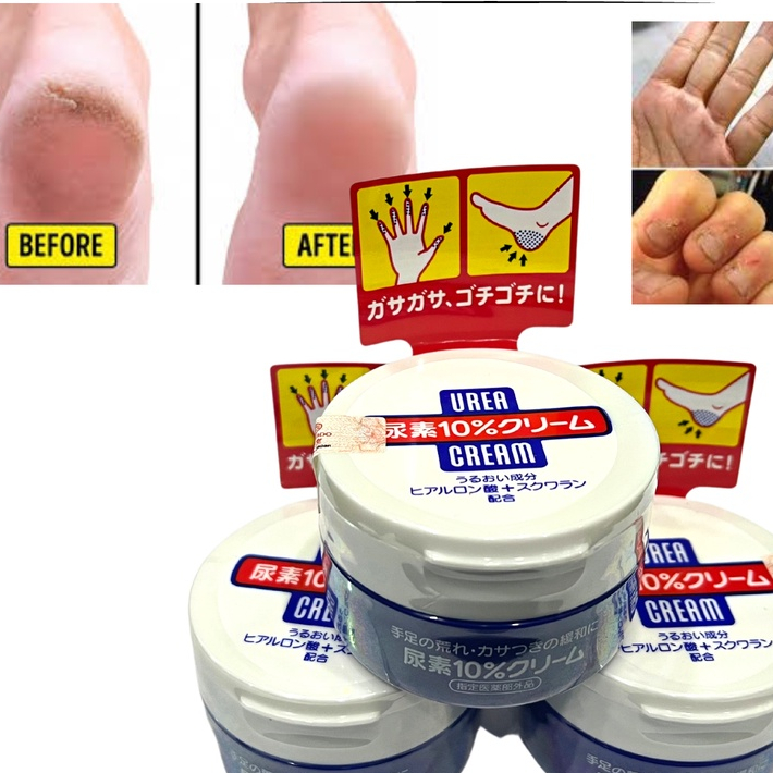 Kem nứt nẻ gót chân shiseido urea cream nhật bản làm hết nứt nẻ gót chân tay đầu gối loại bỏ làn da chai lì thô giá