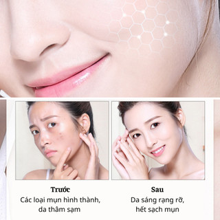 Kem Hết Mụn ZHX Loại Bỏ Mụn và Vết Thâm Hoàn Toàn, Thu Nhỏ Lỗ Chân Lông, Dưỡng ẩm Sáng Da