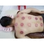 Bộ Giác Hơi Chân Không 32 Cốc Không Dùng Lửa, Giác Hơi Chân Không An Toàn Cho Người Sử Dụng
