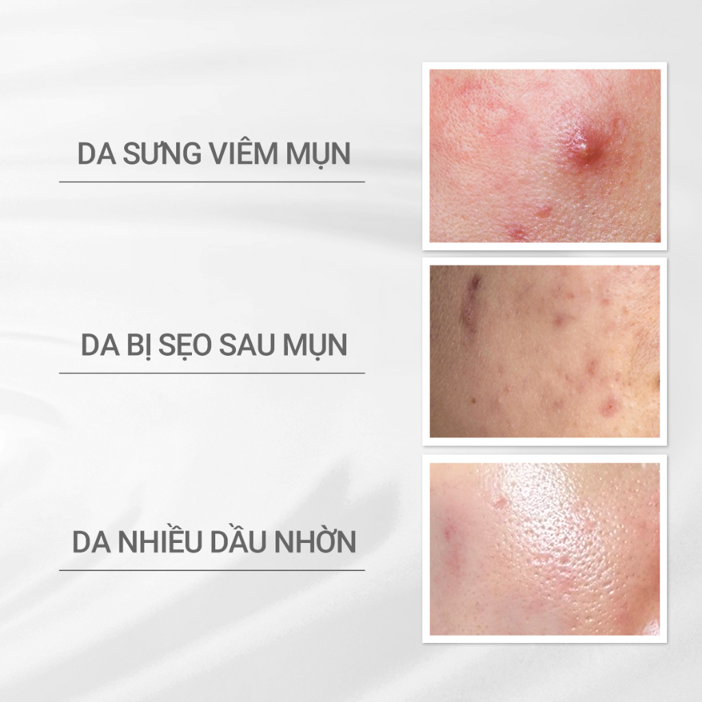 Ảnh Sữa dưỡng cho da mụn nhạy cảm Dprogram Microbiome Acne Care Emulsion 100ml 1
