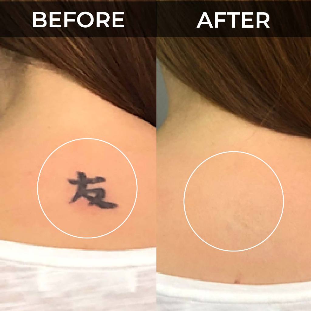 Miếng dán che hình xăm đậm màu tiệp màu da Bellena X3