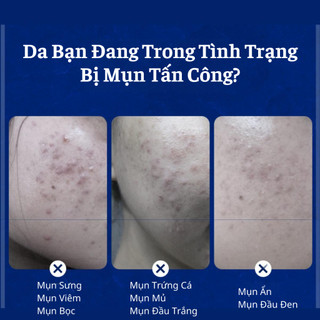 Kem Chấm Sạch Mụn Senana Đánh Bay Các Loại Mụn Sưng Mụn Cơm Mụn Ẩn Mụn Viêm Trên Da 20G