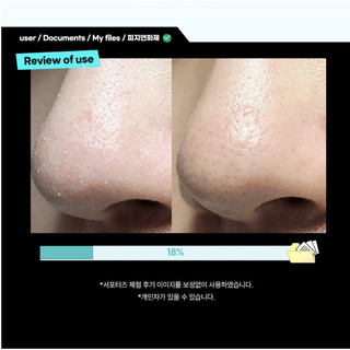 Tinh chất ủ mụn/Cây đẩy mụn ILSO