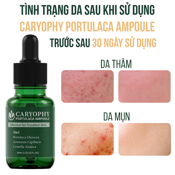 Ảnh Bộ chăm sóc da mụn Caryophy portulaca (serum 30ml toner 300ml) 3