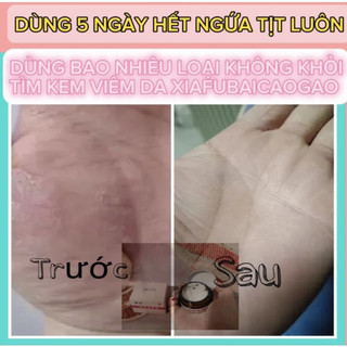 Kem Bôi Viêm Da, Kem Bôi Đông Y Hắc Lào, Á Sừng, Vảy Nến, Chống Nấm Ngứa Đầu, Ghẻ Nước, Lang Ben, Vân Thỏ Beauty