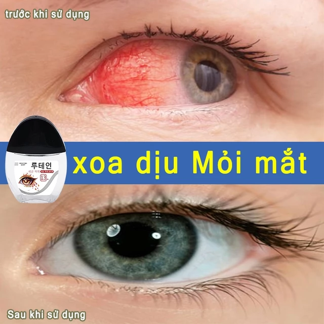 Nước Nhỏ Mắt Loại bỏ mắt đỏ Giúp cải thiện thị lực,Giảm khô mắt giảm mỏi mắt,làm sạch mắt tự nhiên,Giúp Làm Mắt Sáng