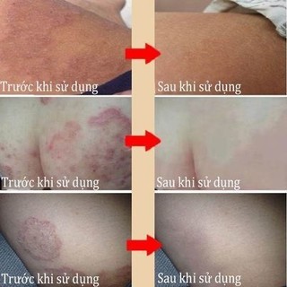 Kem Bôi Ngứa Da Nhật Bản 15g – Giảm Ngứa, Khô Da, Nứt Nẻ, Mẩn Đỏ, Thấm Nhanh Không Nhờn
