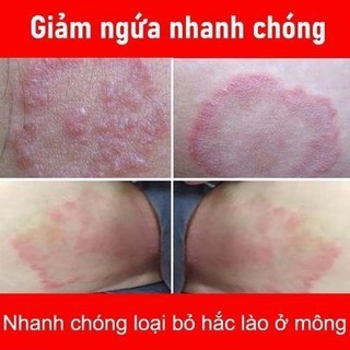 Kem Bôi Ngứa Da Nhật Bản 15g – Giảm Ngứa, Khô Da, Nứt Nẻ, Mẩn Đỏ, Thấm Nhanh Không Nhờn