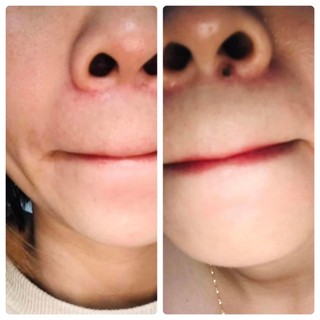 Gel tẩy nốt ruồi (Hồng) tại nhà cam kết tẩy nốt ruồi, mụn cóc, mụn thịt, sẹo lồi gây hại cho da