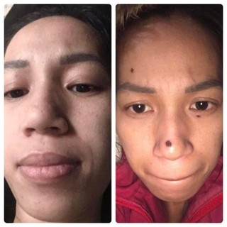 Gel tẩy nốt ruồi (Hồng) tại nhà cam kết tẩy nốt ruồi, mụn cóc, mụn thịt, sẹo lồi gây hại cho da