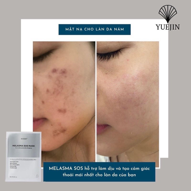 Mặt Nạ Yuejin Melasma SOS - Dưỡng trắng, Giảm nám và Chống lão hóa da (25ml) hạn 2028 IS220