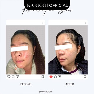 Miếng dán mụn HEALING PATCHES 54 miếng dán chăm sóc làn da mụn, giảm mụn hiệu quả KA GCG