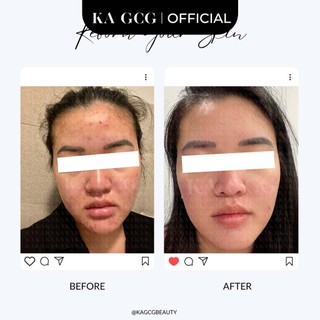 Miếng dán mụn HEALING PATCHES 54 miếng dán chăm sóc làn da mụn, giảm mụn hiệu quả KA GCG