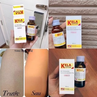 Lotion KELA Dành Cho Da Viêm Lỗ Chân Lông - Thái Lan