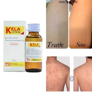Lotion KELA Dành Cho Da Viêm Lỗ Chân Lông - Thái Lan