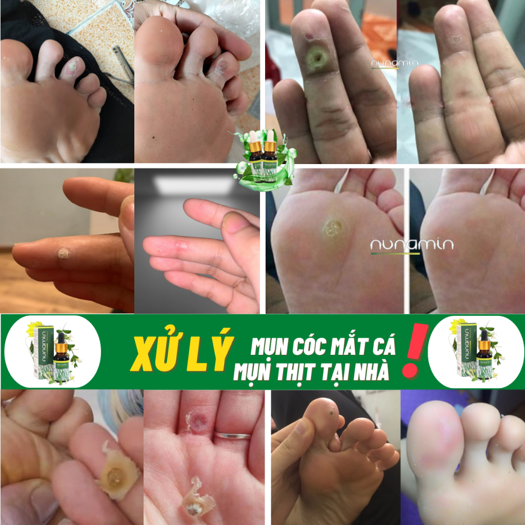 Tinh Chất Tẩy Mụn Cóc, Mụn Cơm, Mắt Cá Chân Tay Lâu Năm [NANUMIN 15ML]