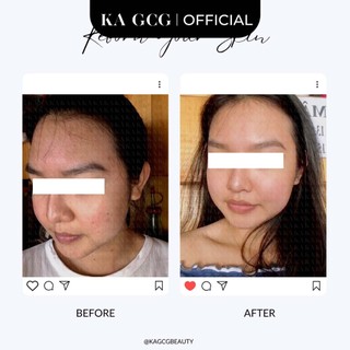 [Sale cận date] Tinh chất dưỡng da BLEMISH + ACNE DEFENSE giúp ngừa mụn, giảm thâm 30ML KA GCG