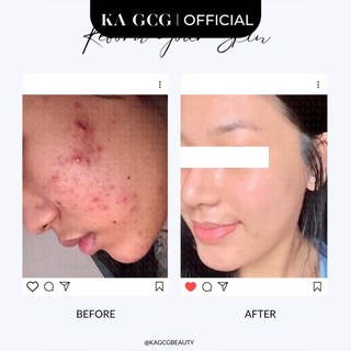 [Sale cận date] Tinh chất dưỡng da BLEMISH + ACNE DEFENSE giúp ngừa mụn, giảm thâm 30ML KA GCG