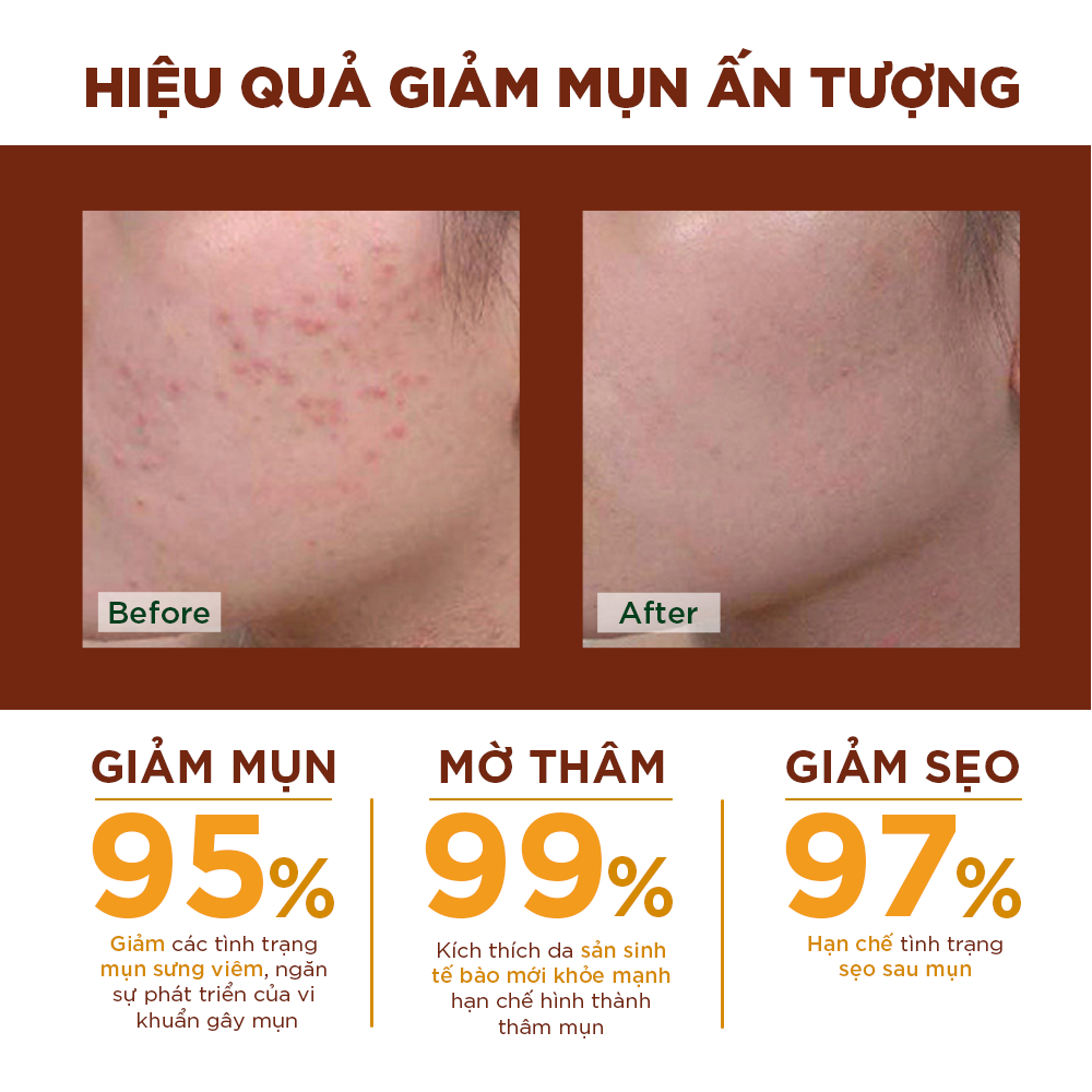 Kem nghệ Oriss ngừa mụn giảm thâm mờ sẹo dạng gel không màu không gây vàng da Tuýp 20gr