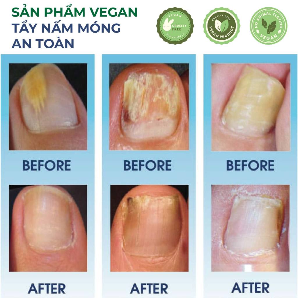 Serum nấm móng tay chân dưỡng cứng dài móng Bellena Nail Care Serum