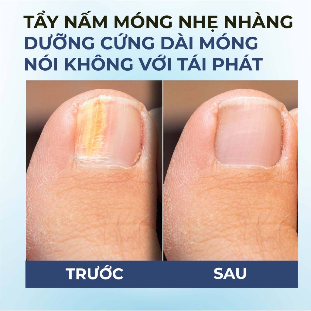 Serum nấm móng tay chân dưỡng cứng dài móng Bellena Nail Care Serum
