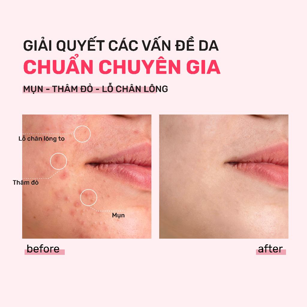 Ảnh Bộ Đôi Kiềm Dầu, Ngừa Mụn, Thu Nhỏ LCL Serum Niacinamide 20% 30ml, Mặt Nạ Đất Sét Derladie Vegan Pink Clay Mask 3