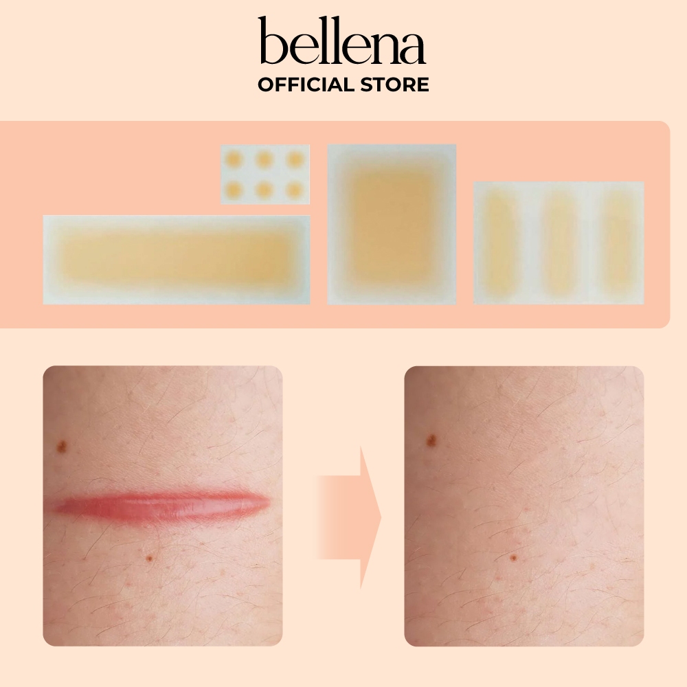 Miếng dán che sẹo khuyết điểm nốt ruồi sẹo lồi sẹo lõm mụn tiệp màu da Bellena S1