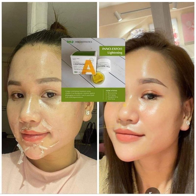 Peel A Lightening Inno giúp da mềm mịn, căng bóng, trắng sáng