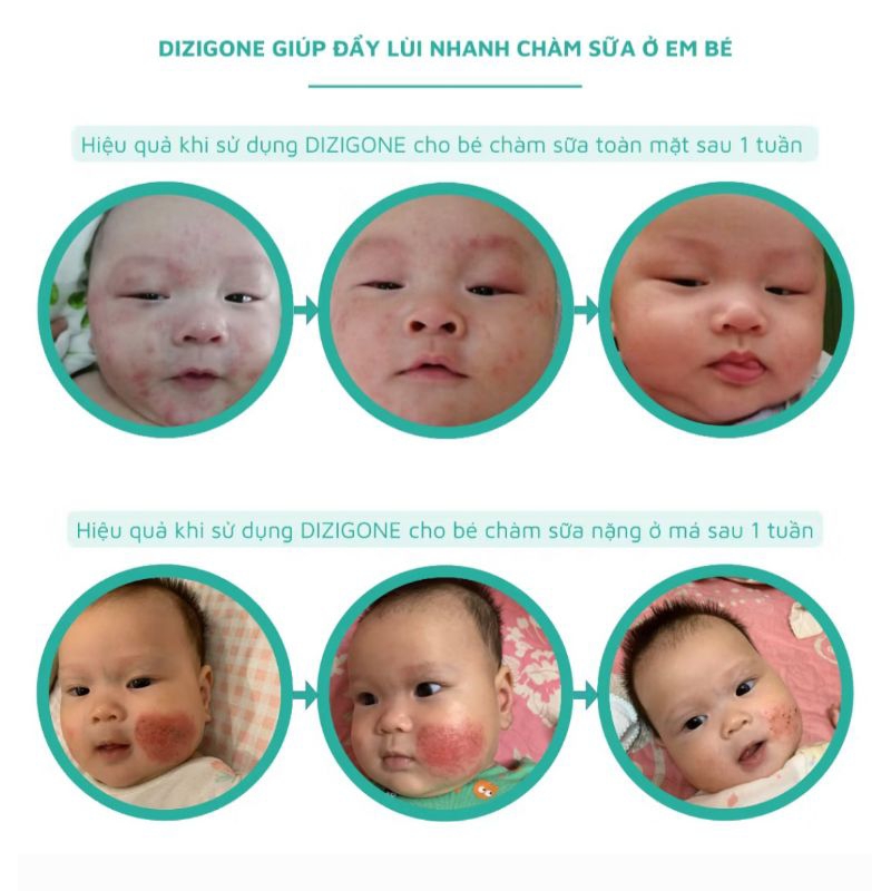 Kháng khuẩn DIZIGONE BABY - Eco enzymeX Baby trị ngứa không kh sinh, không tái phát