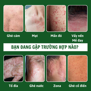 [Ghẻ lở] Kem bôi da ghẻ lở ngứa nấm Fengcha cho người bị ghẻ ngứa lâu năm bôi nhiều loại rồi mà chưa khỏi hũ 10gram