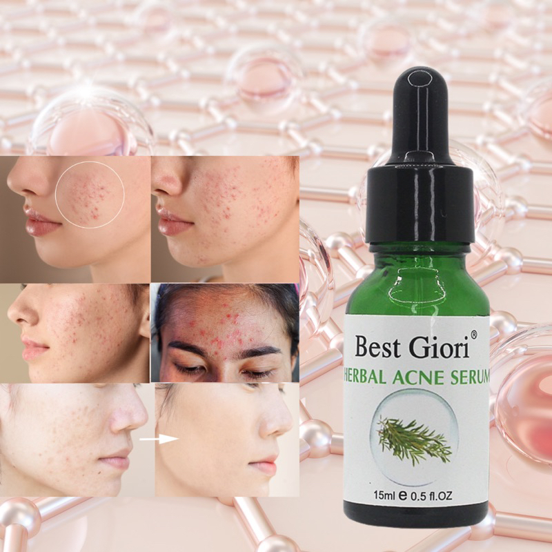 Serum giảm mụn thâm và làm dịu da, kiểm soát dầu BEST GIORI 15ml
