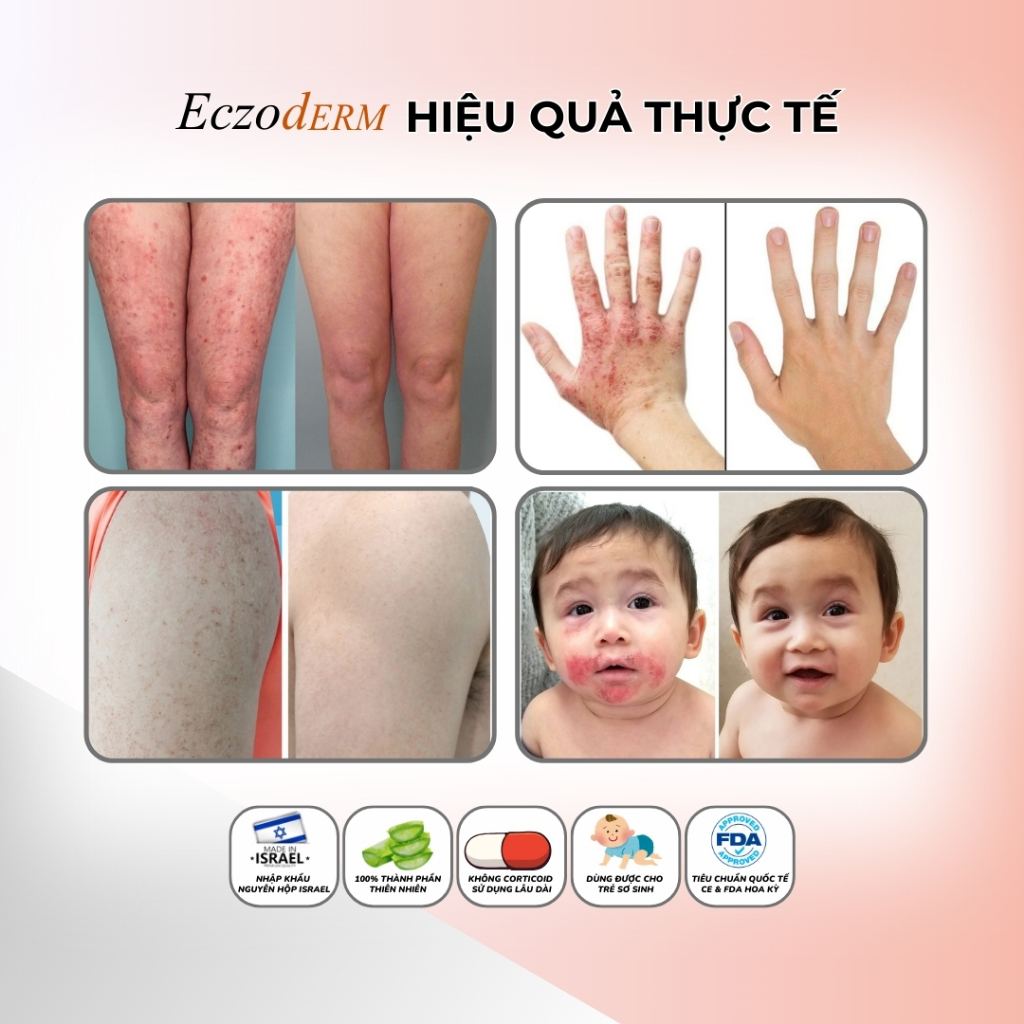 Combo 2 Kem Eczoderm Bôi Viêm Nang Lông, Viêm Da Cơ Địa, Chàm Sữa Trẻ Em, Chính Hãng DanPharm Israel