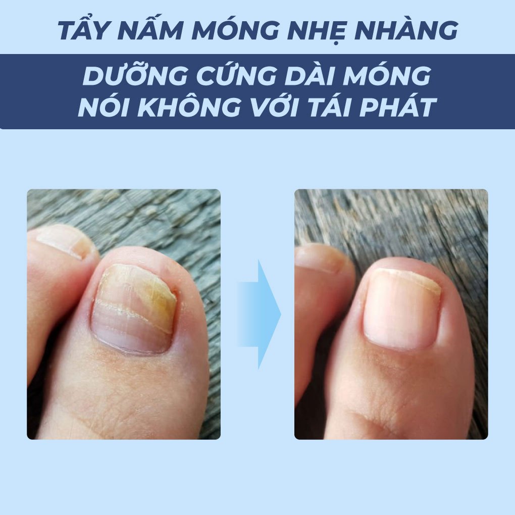 Serum nấm móng tay chân dưỡng cứng dài móng an toàn và hiệu quả Bellena Nail Care Serum
