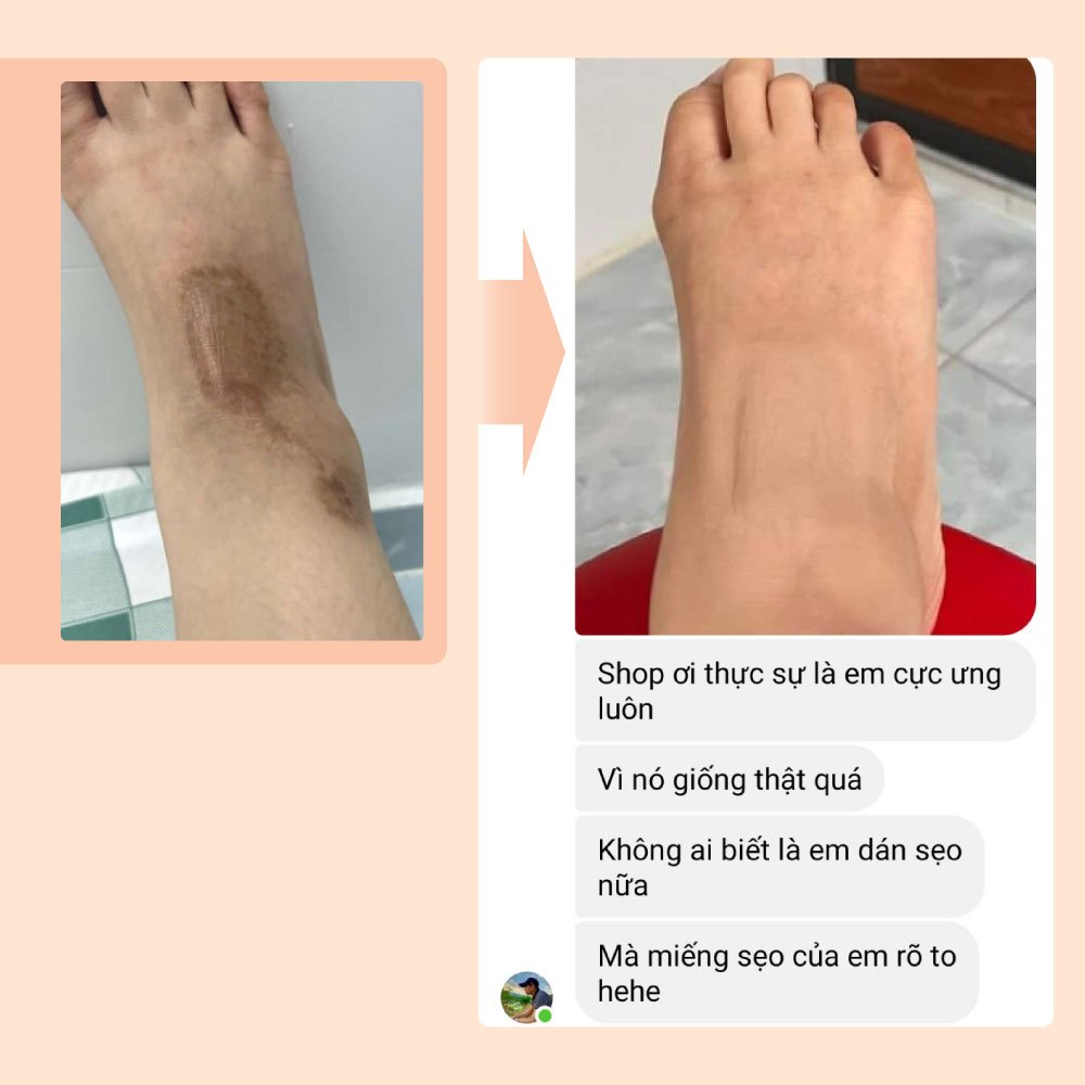 Miếng dán che sẹo khuyết điểm nốt ruồi sẹo lồi sẹo lõm mụn tiệp màu da Bellena S1