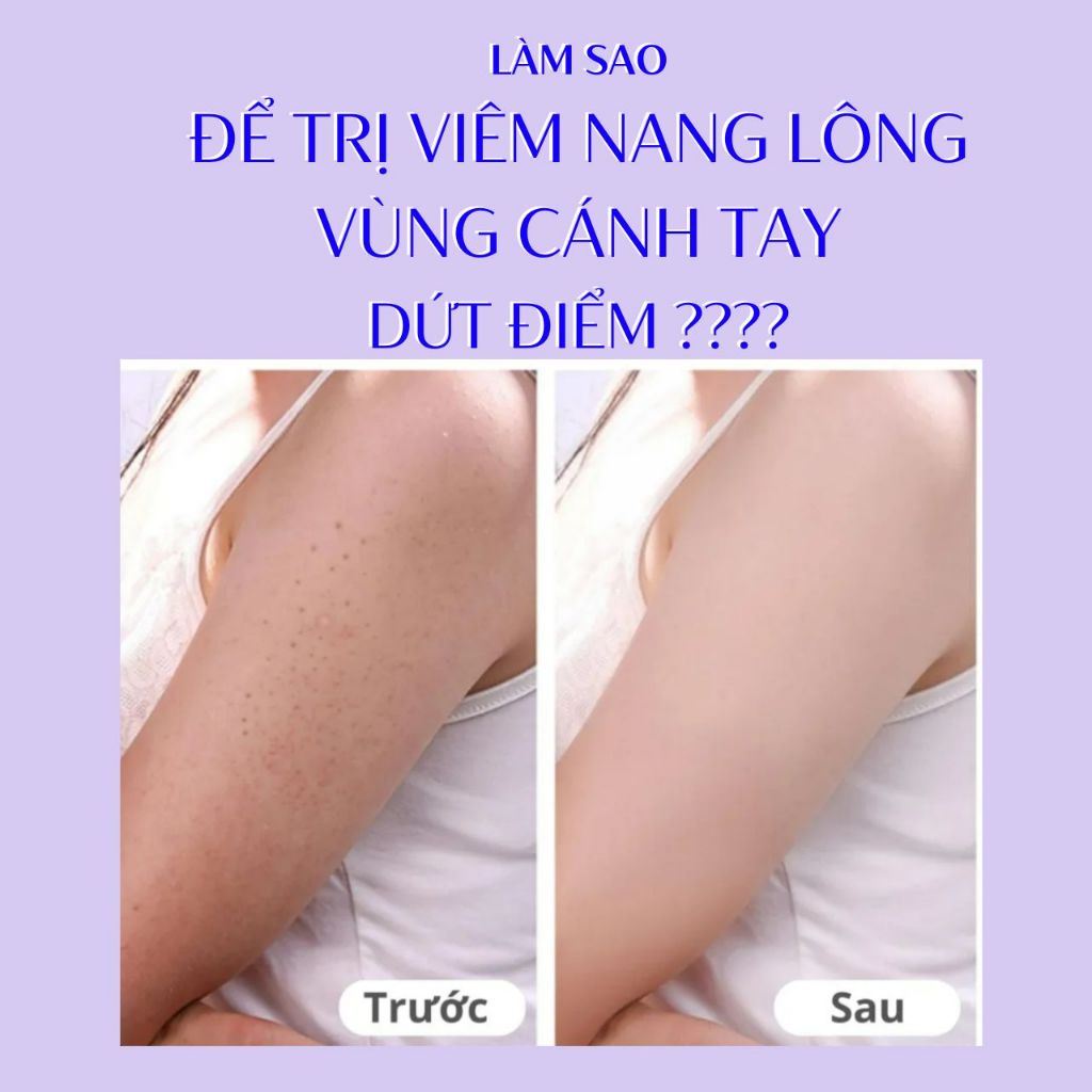 Xà Phòng Tằm Viêm Nang Lông Vùng Cánh Tay Pelican Baking Soda Soap