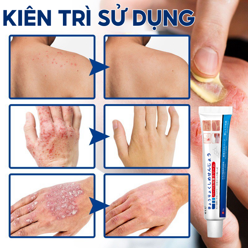 Kem Bôi Nấm Ngứa Viêm Da Cơ Địa NHẬT BẢN Hắc Lào, Tổ Đỉa, Vẩy Nến, Á Sừng, Lang Ben Hiệu Quả