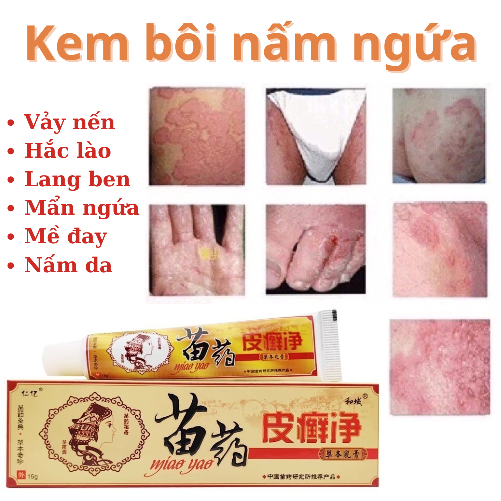[Miao Vàng] CHÍNH HÃNG Kem bôi giảm ngứa, Kem bôi hắc lào mề đay tổ đỉa viêm da nấm da đầu nước ăn chân tay 15gr