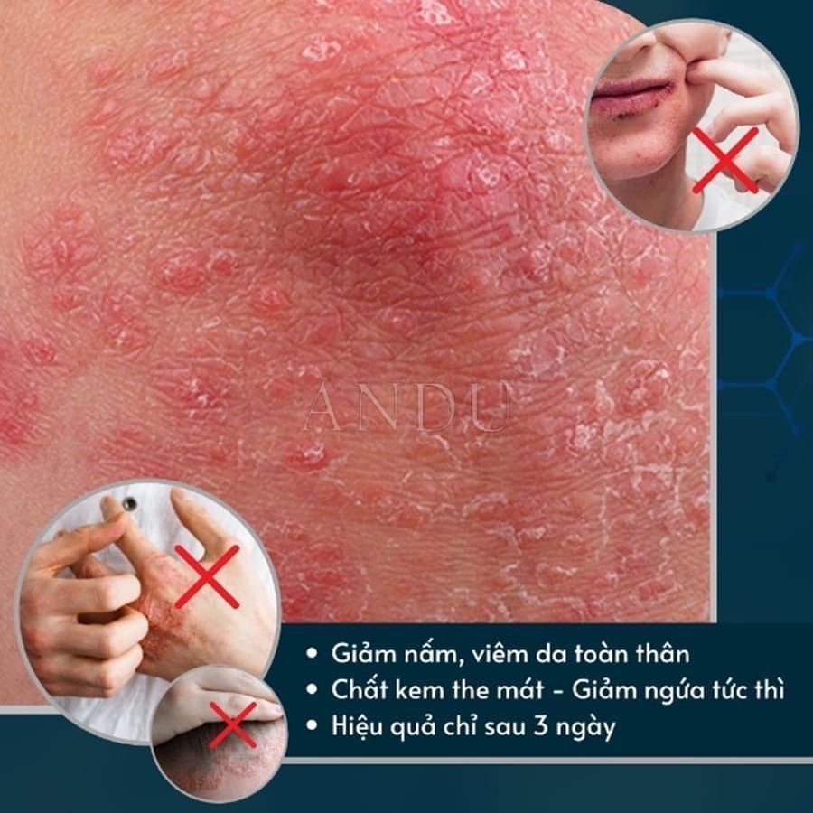 Kem Bôi Nấm Ngứa Viêm Da Cơ Địa NHẬT BẢN Hắc Lào, Tổ Đỉa, Vẩy Nến, Á Sừng, Lang Ben Hiệu Quả