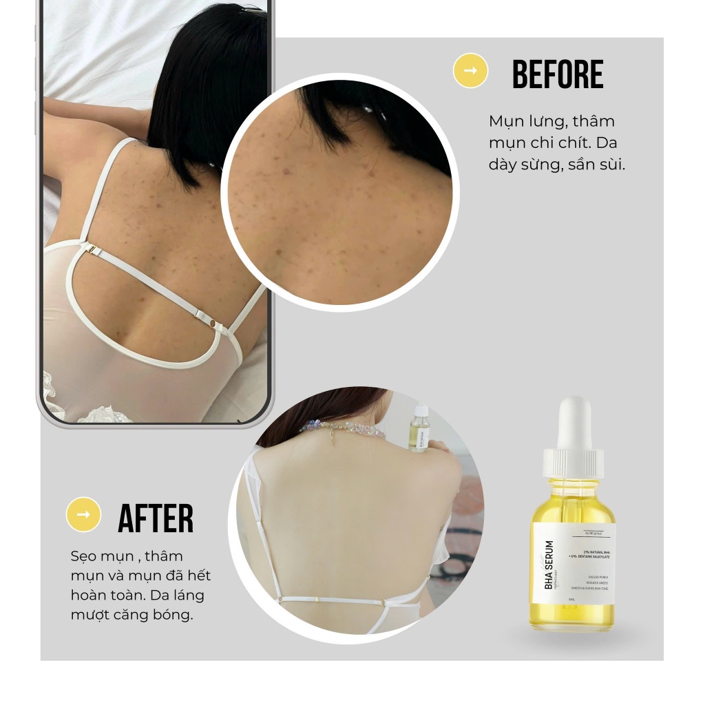 BHA Serum 8%15ml ND giảm mụn Face & Body,giảm viêm nang lông,thu nhỏ lỗ chân lông,tẩy tế bào chết,..