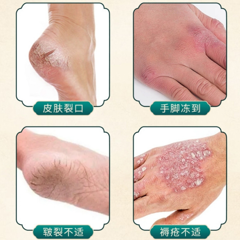 Kem viêm da cơ địa Nội địa Trung 30g hết ngứa tái tạo da Kem bôi nứt nẻ gót chân an toàn H13