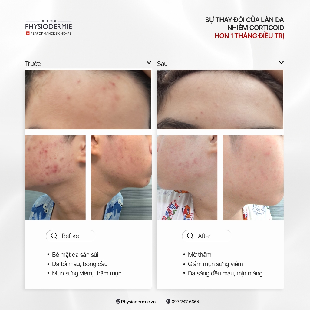 Ảnh Bộ đôi Actinyl giảm mụn nội tiết, mụn sưng viêm Actinyl Duo 4