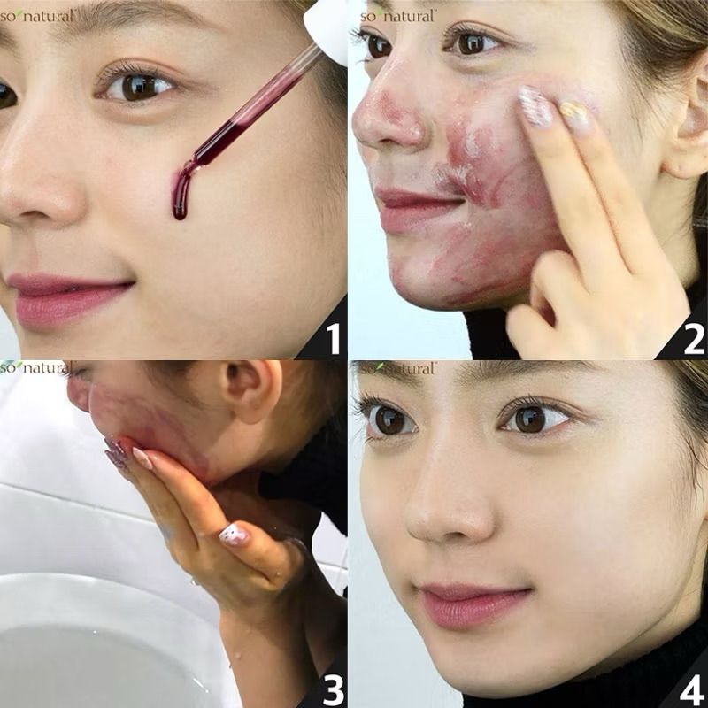 [PHIÊN BẢN MỚI 11ml] Red Peel Tingle Serum Tinh Chất Tái Tạo Da So’ Natural ( 35ml )