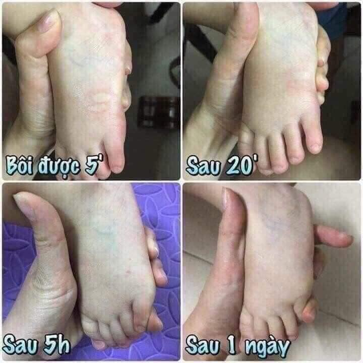 KEM BÔI MUỖI ĐỐT THÁI LAN HƯƠNG SẢ AN TOÀN CHO BÉ