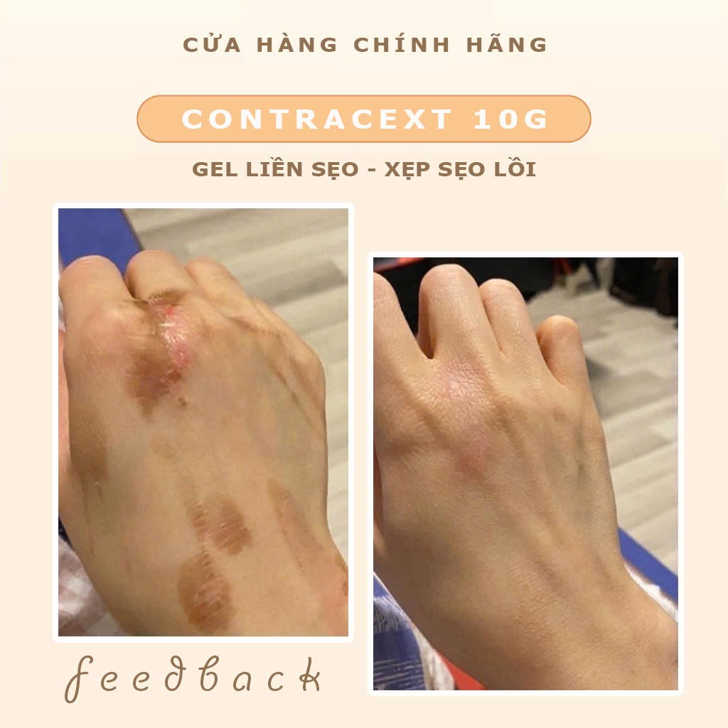 Gel cải thiện sẹo, sẹo lõm, sẹo thâm Contracext tuýp 10mg giảm và mờ sẹo Nga Beauty